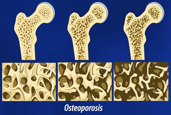 osteoporosis 骨粗しょう症が若年層の間で広がる！若い女性も2近くが予備軍に！